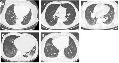 Evaluating cardiac function with chest computed tomography in acute ischemic stroke: feasibility and correlation with short-term outcome